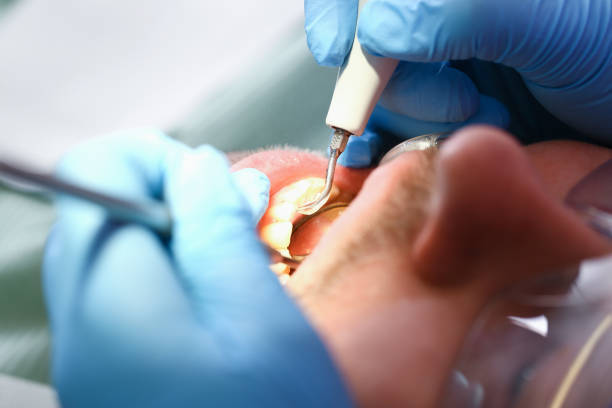 Best Emergency Tooth Extraction in Lusby, MD